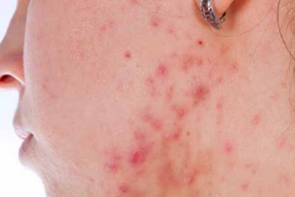 Skincare Basics: What is Acne and How to Treat It