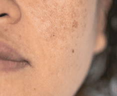 Melasma & Hyperpigmentation