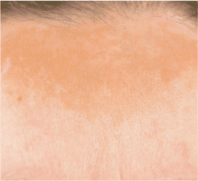 Melasma