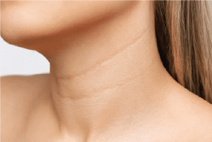 Neck Wrinkles & Sagging