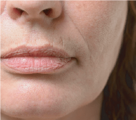 Collagen Degradation