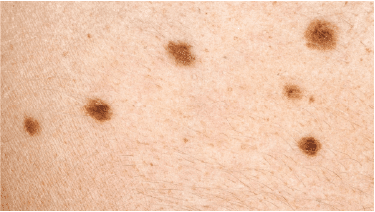 Skin Cancer