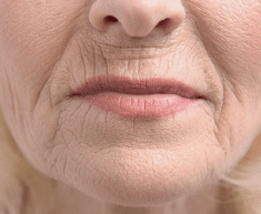 Collagen & Hyaluronic Acid Loss