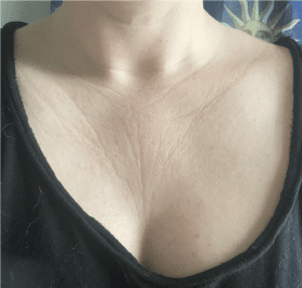 Chest Wrinkles & Crepiness