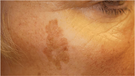 Pigmentation & Sun Spots