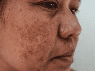 Post-Inflammatory Hyperpigmentation (PIH)