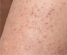 Keratosis Pilaris