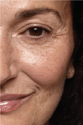 Post-Menopausal Skin
