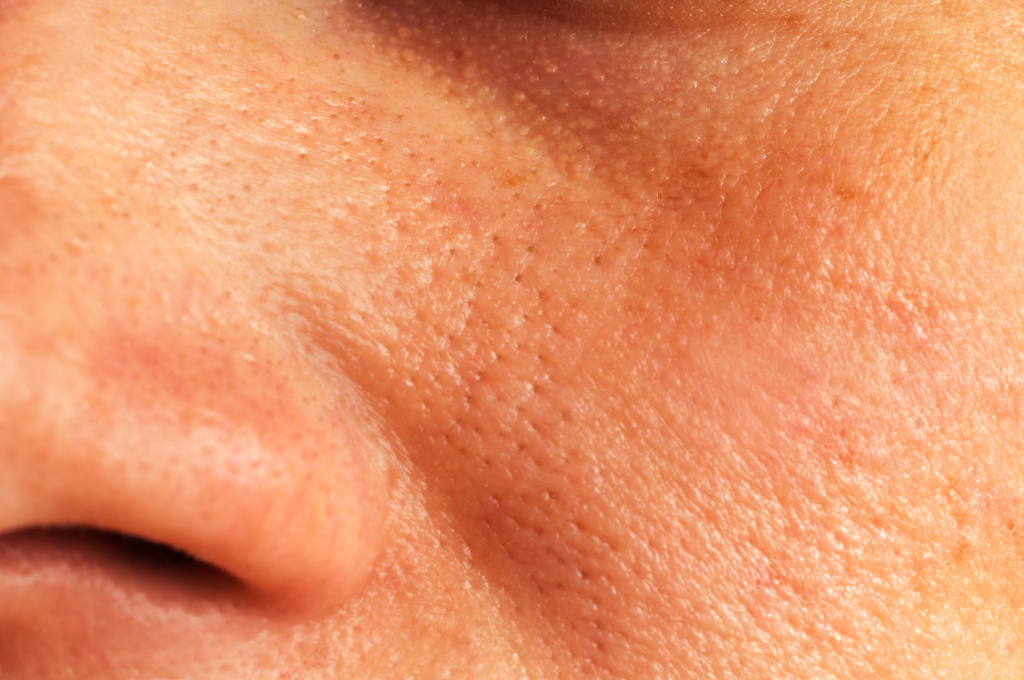 The Truth About Shrinking Enlarged Pores