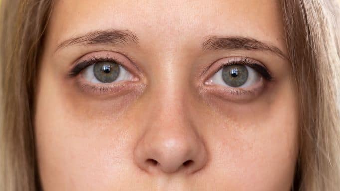 Dark Circles: Causes, Treatments, and Skincare Tips