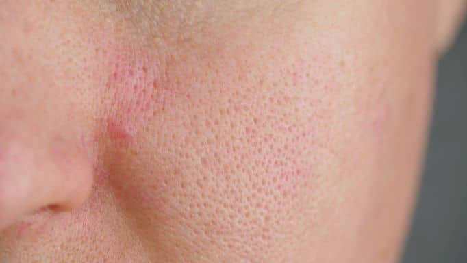 How to Deep Cleanse Facial Pores