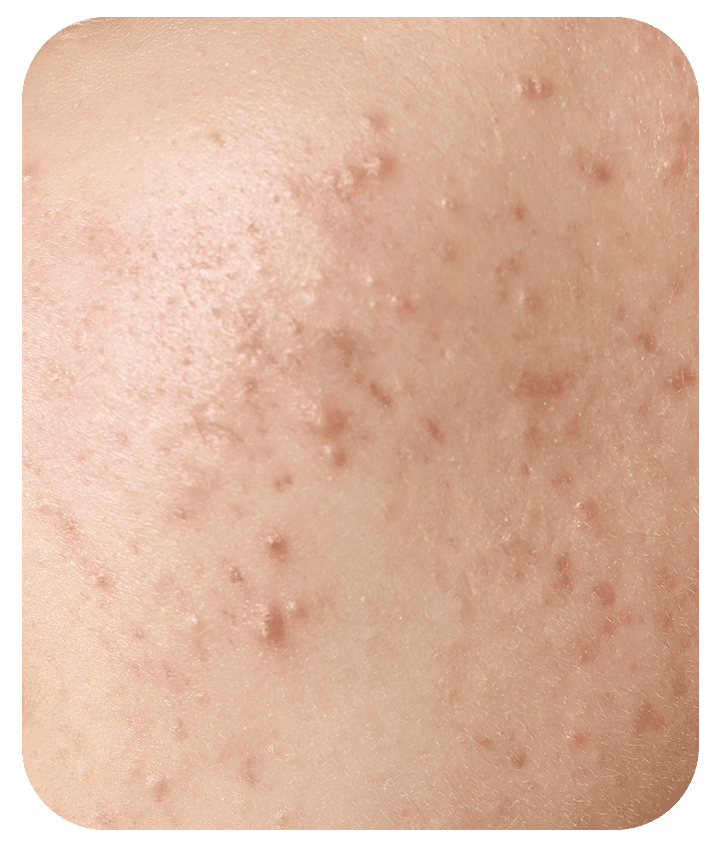 Designed to address Acne