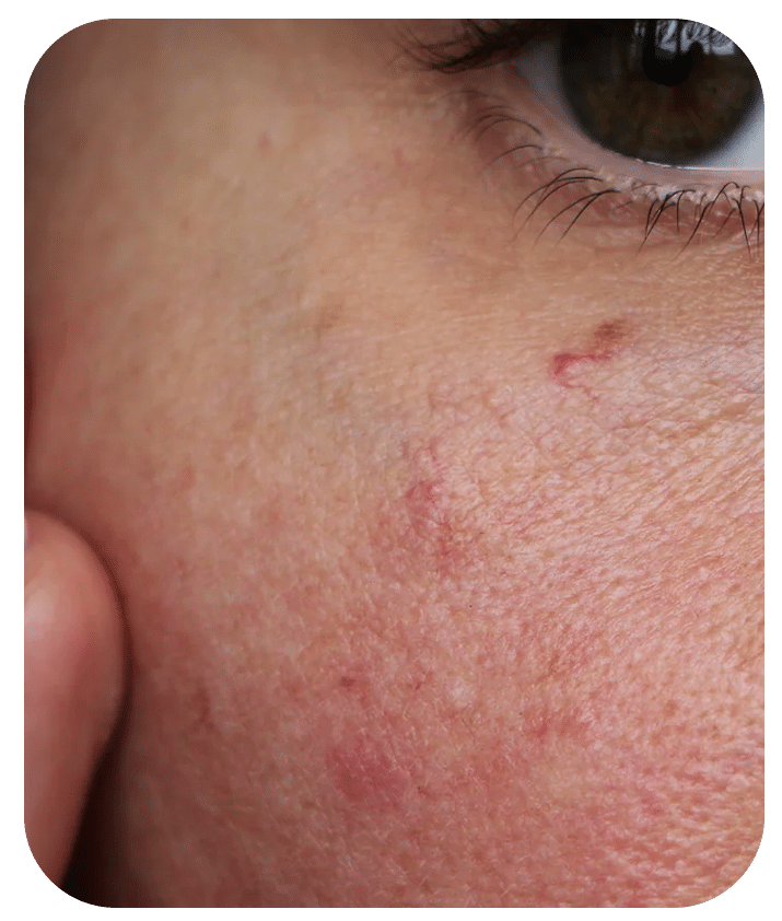 Designed to address Irritation