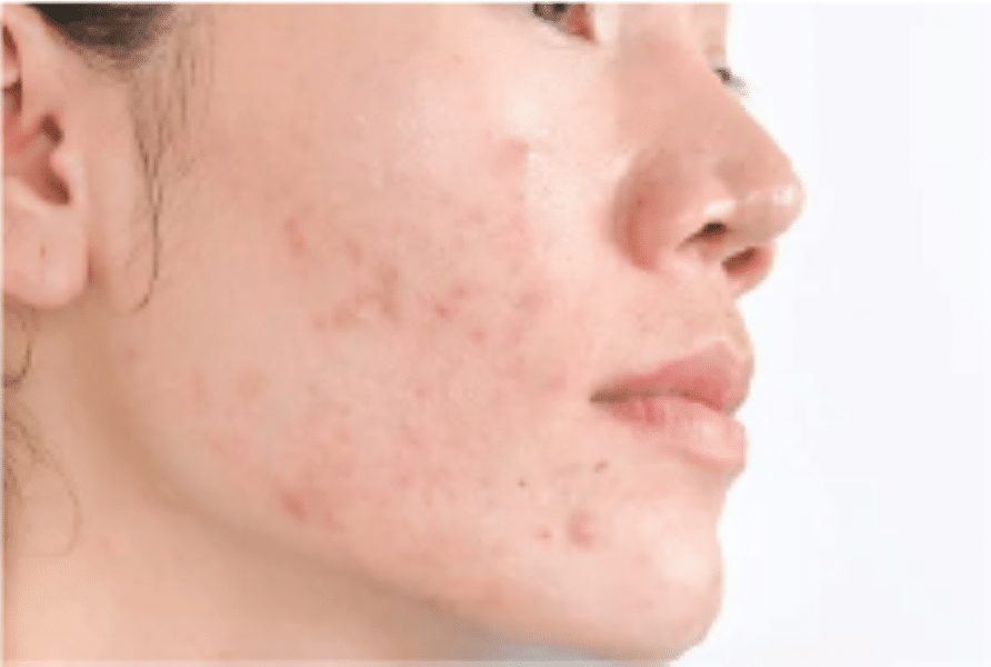 Post-Inflammatory Hyperpigmentation (PIH)