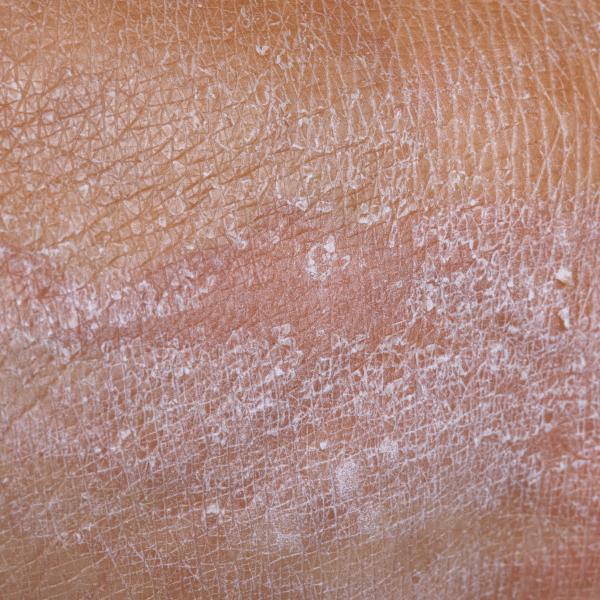 Keratin Buildup