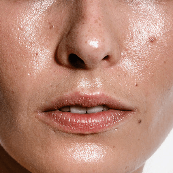 Sebum and Scale