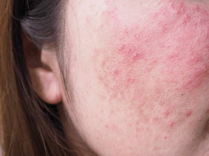 Inflammation and Barrier Stress