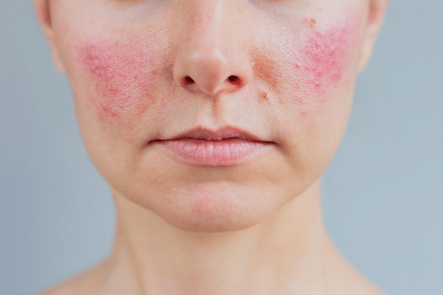 Immune Inflammation